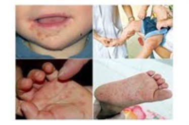 Xử trí và phòng bệnh tay chân miệng cho trẻ