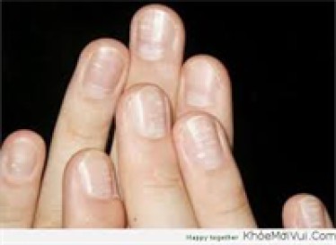 Dấu hiệu cho biết cơ thể đang thiếu kẽm