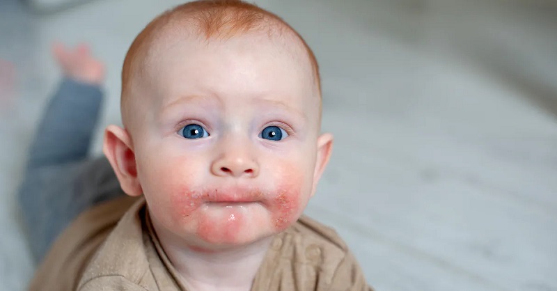 Dị ứng thức ăn ở trẻ và cách xử trí