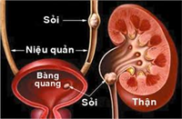 Nguy biến do thừa canxi